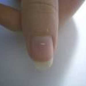Білі плями на нігтях - причини появи