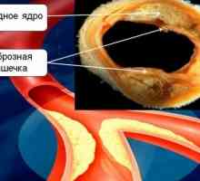 Що таке атеросклероз судин