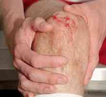 Як лікувати колінний синовіт