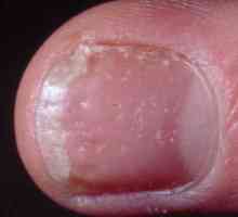 Як лікувати псоріаз нігтів