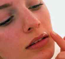 Лікування застуди на губі