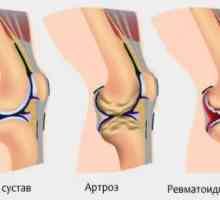 Лікування суглобів ніг