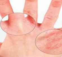 Симптоми контактного дерматиту