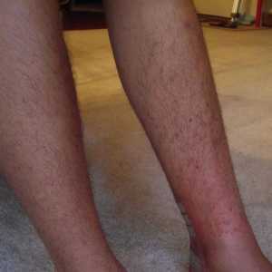 Чешущіеся висип на ногах: причини, профілактика