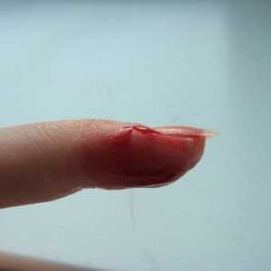 Як зупинити кров з пальця